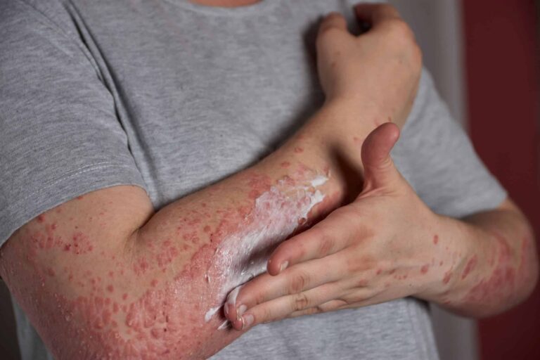 herpes-zoster:-o-que-e-e-como-ele-se-relaciona-com-a-catapora?
