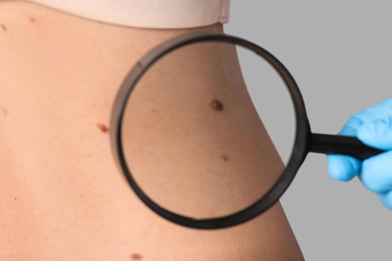 quais-os-tipos-de-cancer-de-pele?-descubra-as-diferencas,-diagnosticos-e-tratamentos